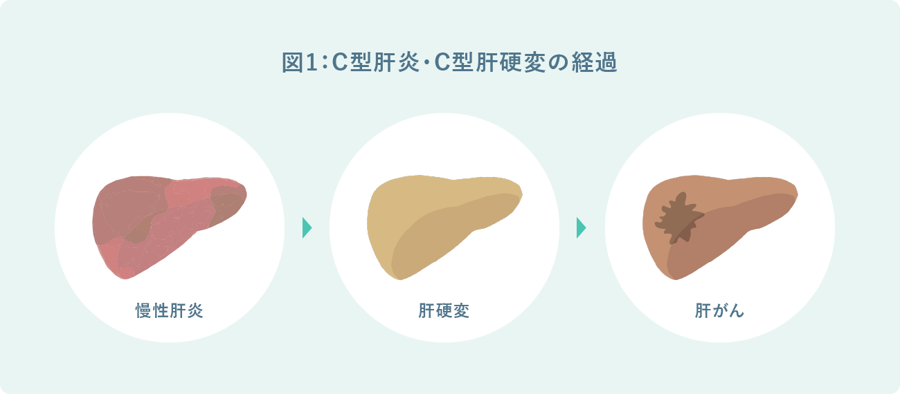 図1：C型肝炎～C型肝硬変～肝がんへの経過（イメージ）